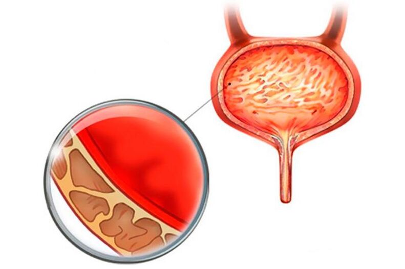 Inflamación da membrana mucosa da vexiga con cistite